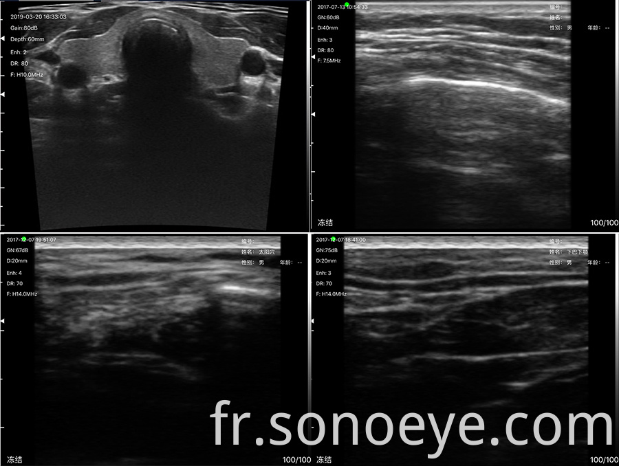 porket ultrasound